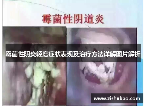 霉菌性阴炎轻度症状表现及治疗方法详解图片解析